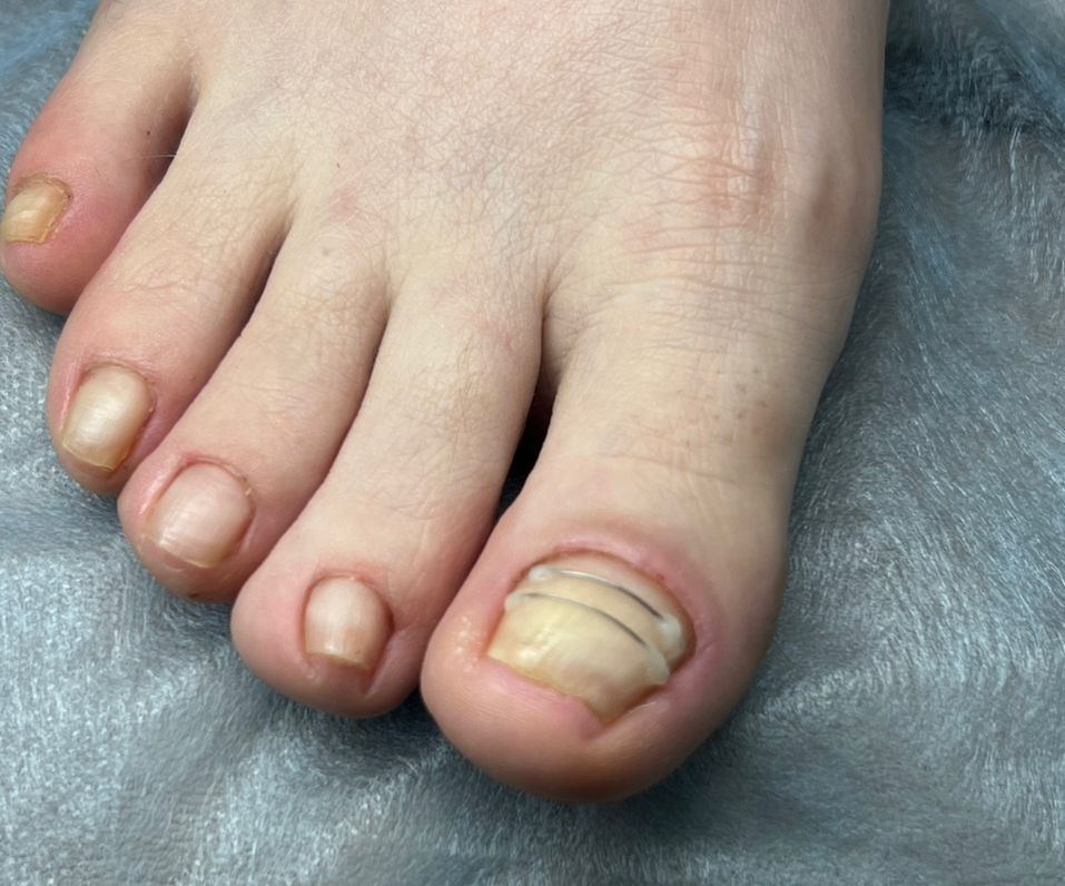 Установка титановой нити