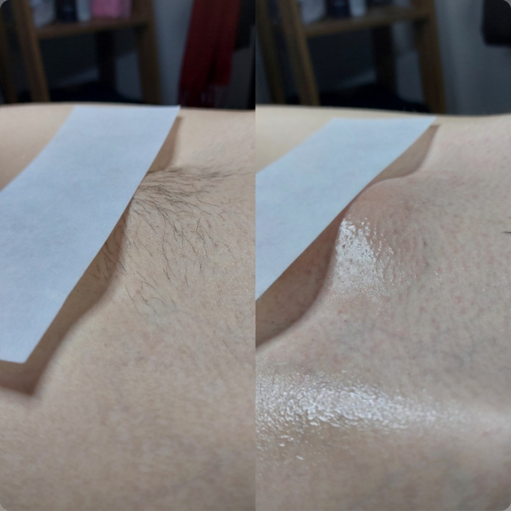 Бикини глубокое (удаление вросших волос/удаление полоски на животе)