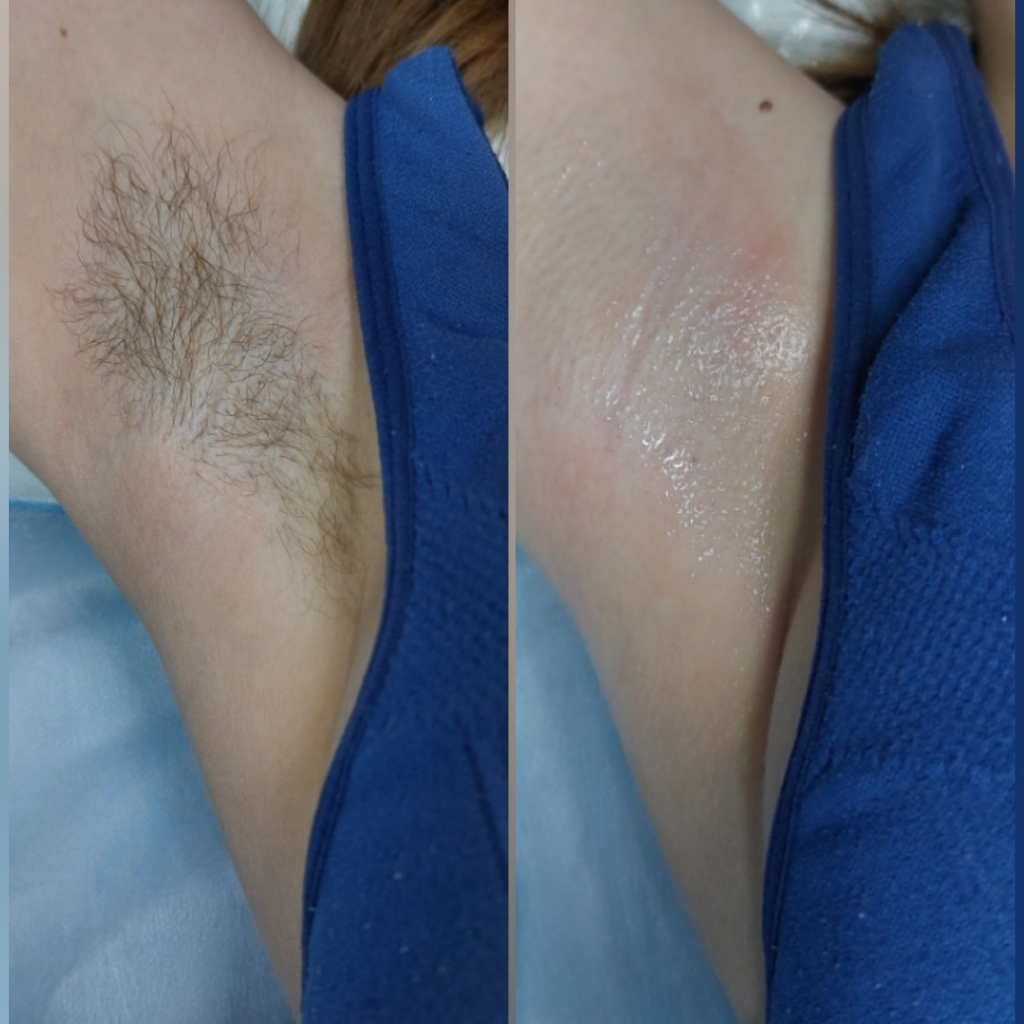 Подмышечные впадины