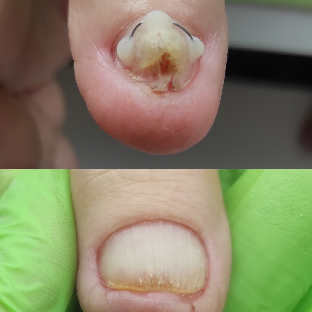 Титановая нить на руках и ногах.