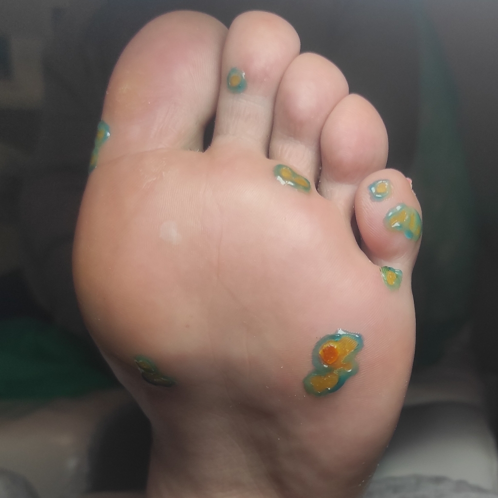 Подошвенные и ладоные бородавки.