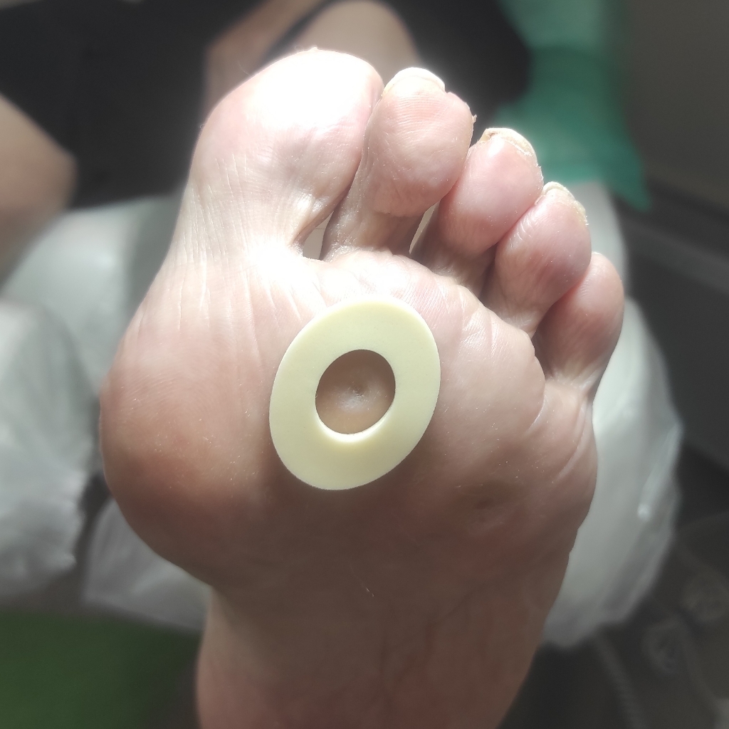 Стержневые мозоли. Обработка и разгрузка.