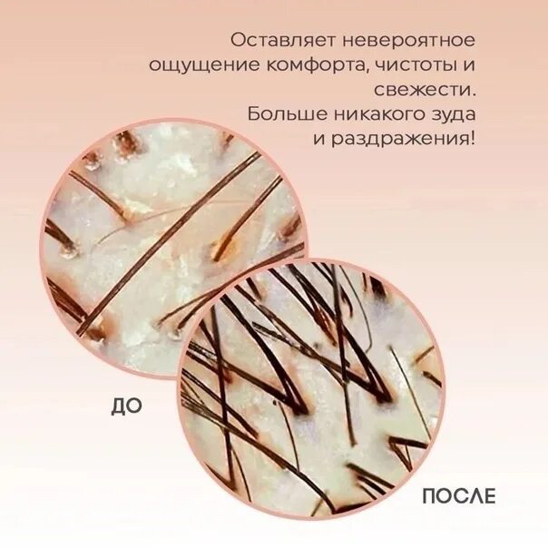 Пилинг кожи головы