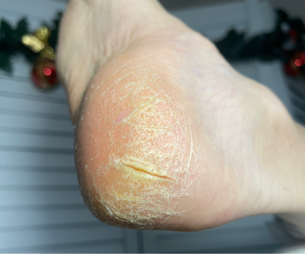 Сложная стопа - подология  (трещины, стержневые мозоли, диабетическая стопа ) без покрытия.