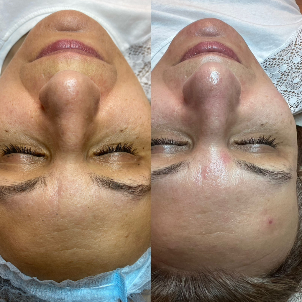 Миндальный пилинг