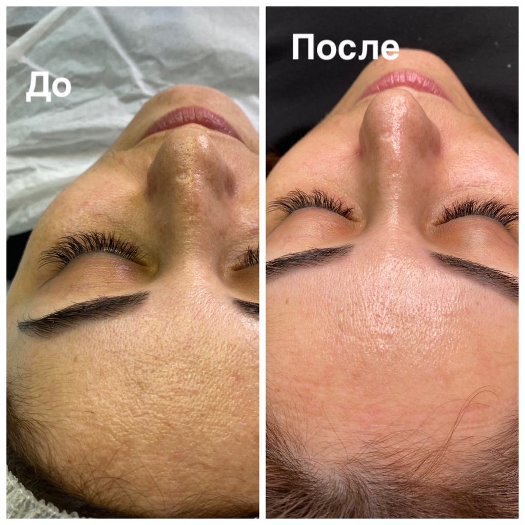 Химический пилинг -азелиновый