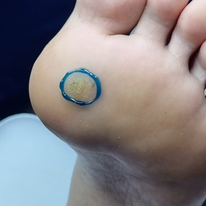 Удаление бородавки (азотной кислотой)