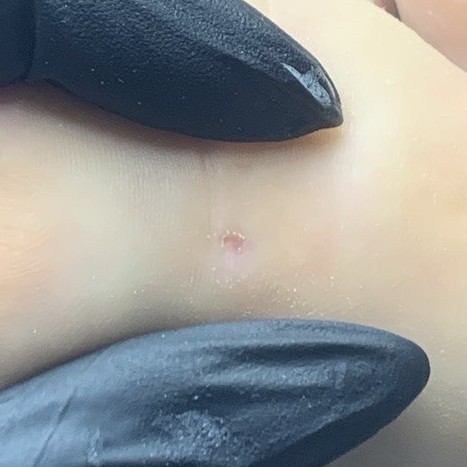 Стержневая мозоль