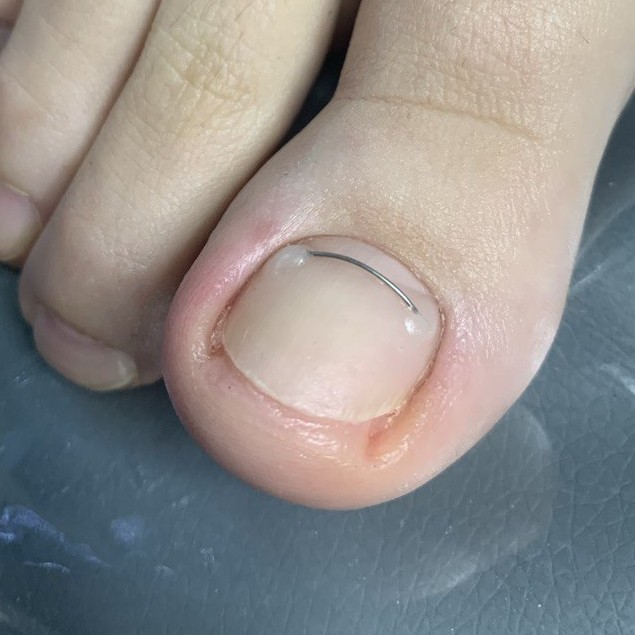 Установка титановой нити