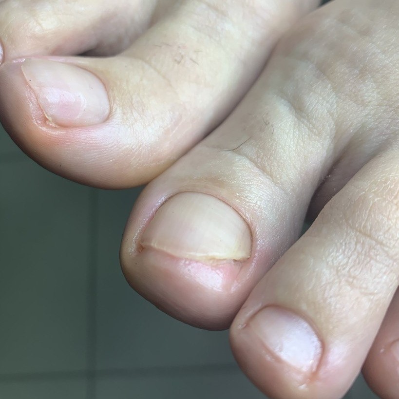 Онихолизис/онихогрифоз/деформированный ноготь