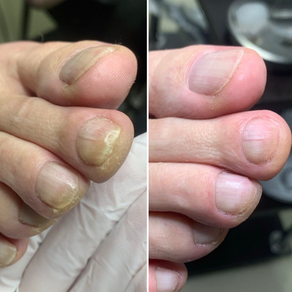 Первичный визит, обработка ногтей