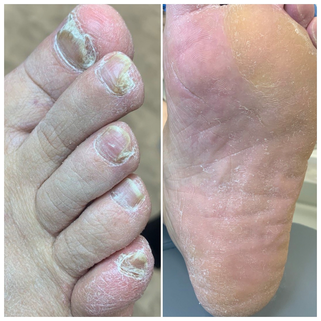 Первичный визит, обработка ногтей и стопы