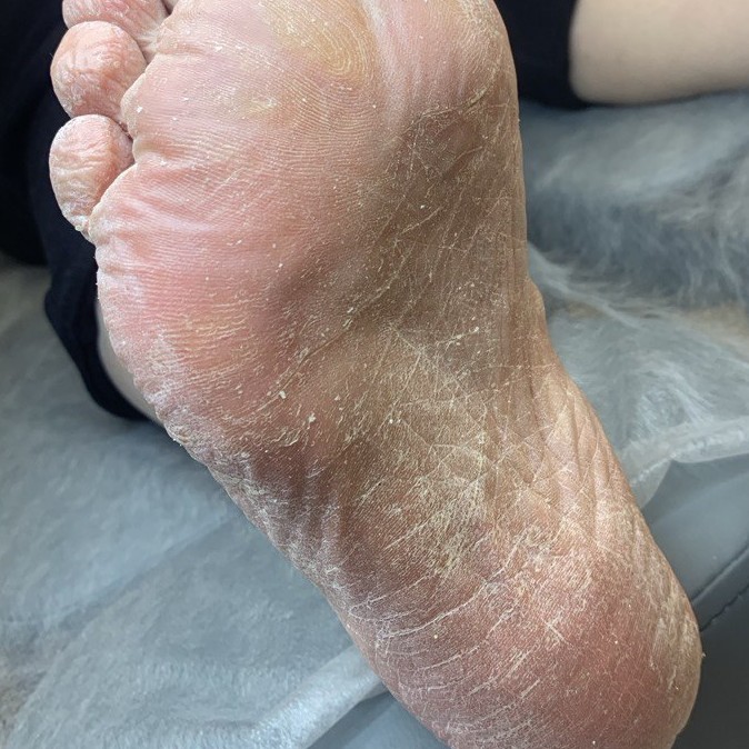 Первичный визит, обработка стопы