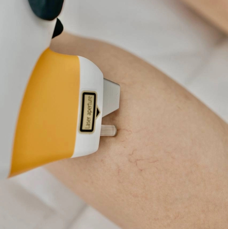 Удаление сосудов лазером на ногах от 1 см.кв.