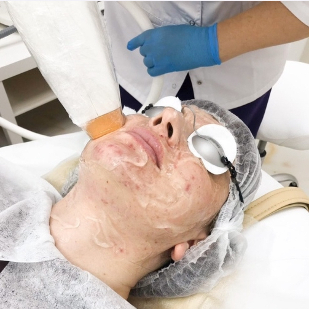 Лазерное лечение акне на лице, шее и декольте