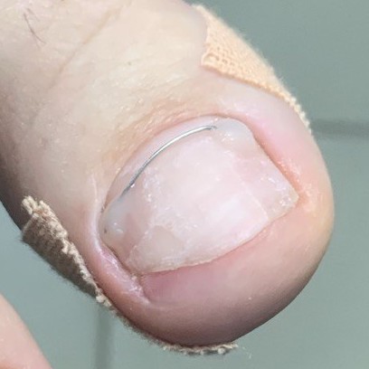 Коррекция титановой нити