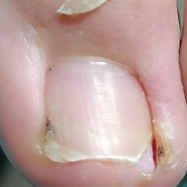 Обработка вросшего ногтя