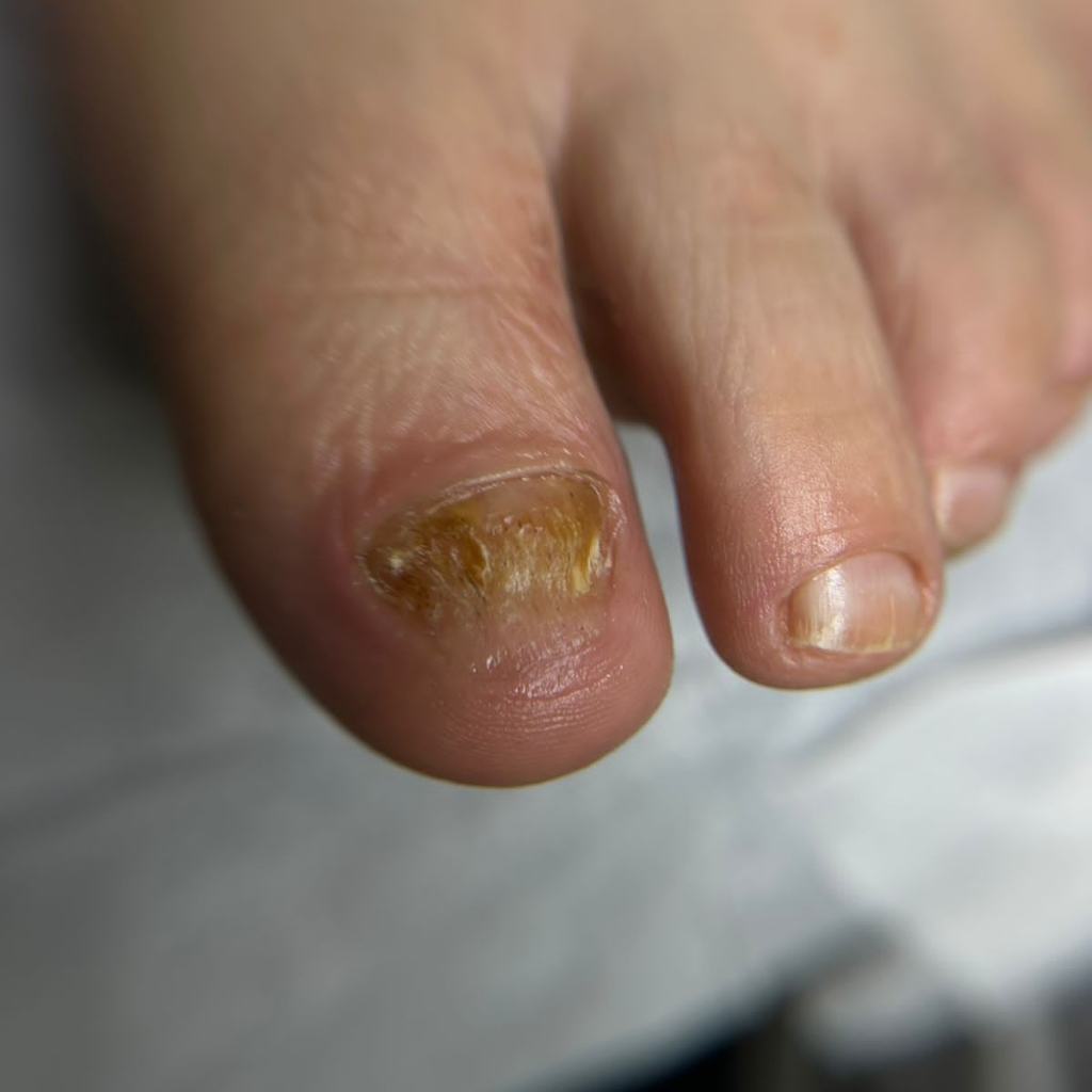 Подологический педикюр