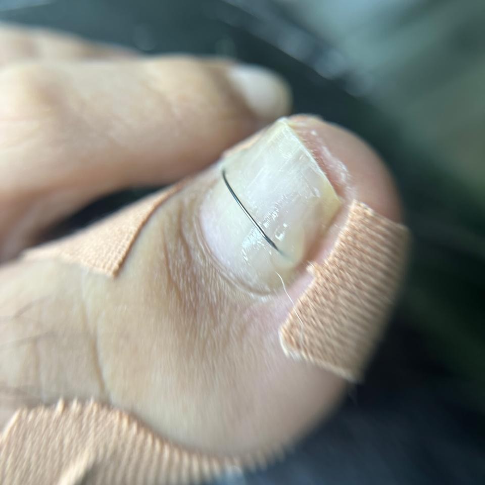 Установка коррекционной системы (титановая нить)