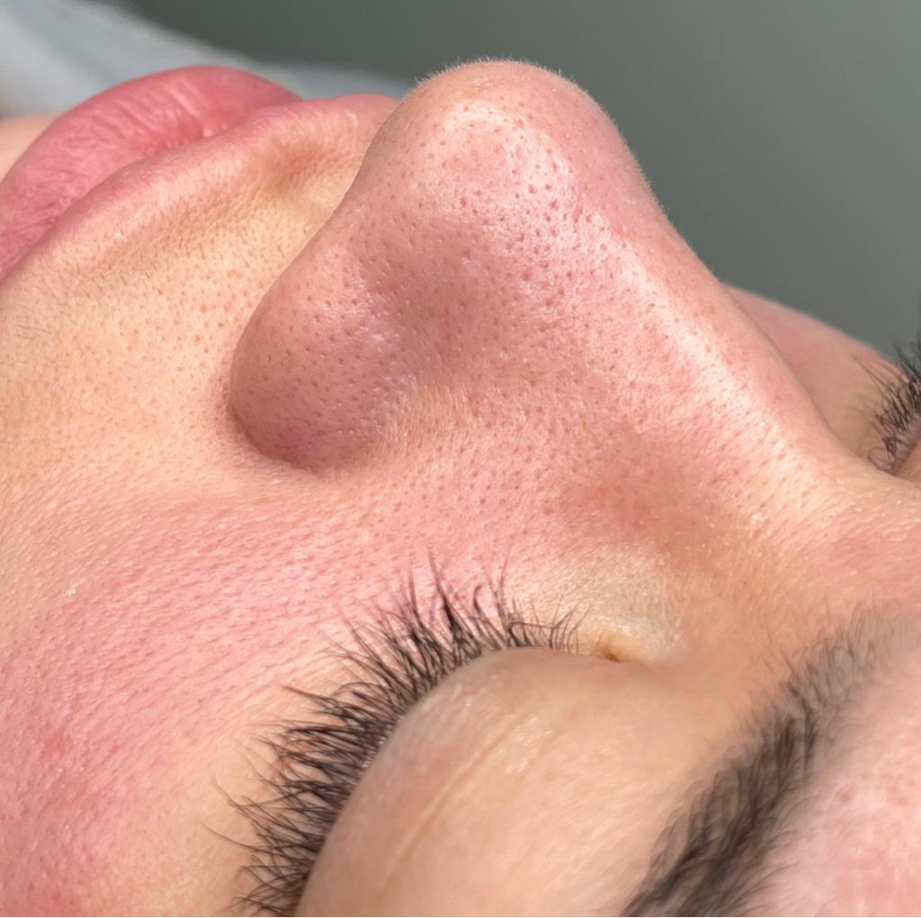 АКЦИЯ чистка лица + каброкситерапия