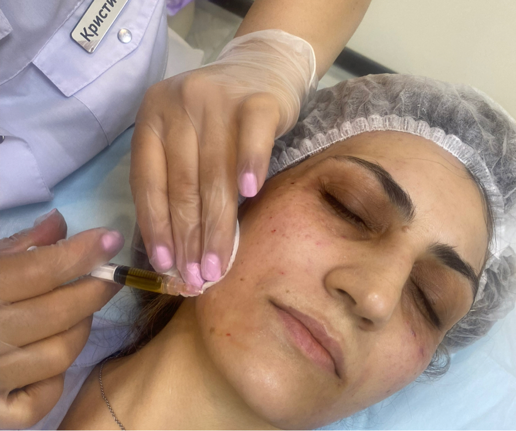 Мезотерапия для лица