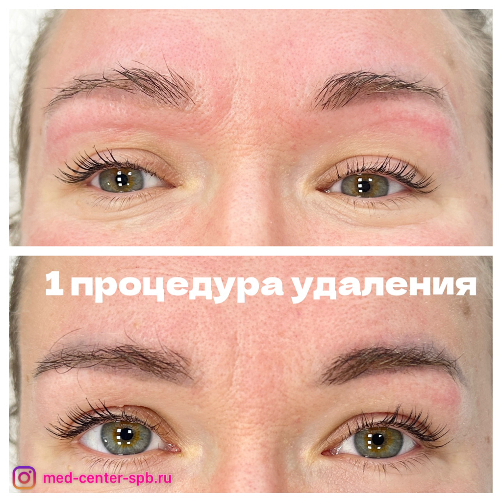 Удаление перманента