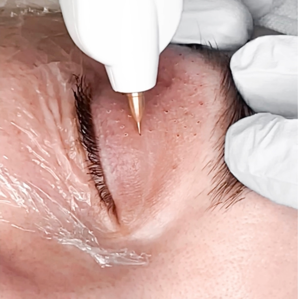 Блефаропластика верхнего века