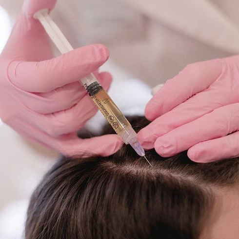 Мезотерапия волосистой части головы