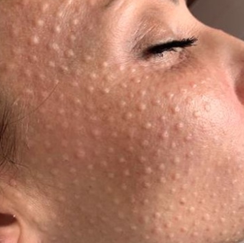 Мезотерапия кожи лица и шеи dermaheal (юж Корея/ Испания )