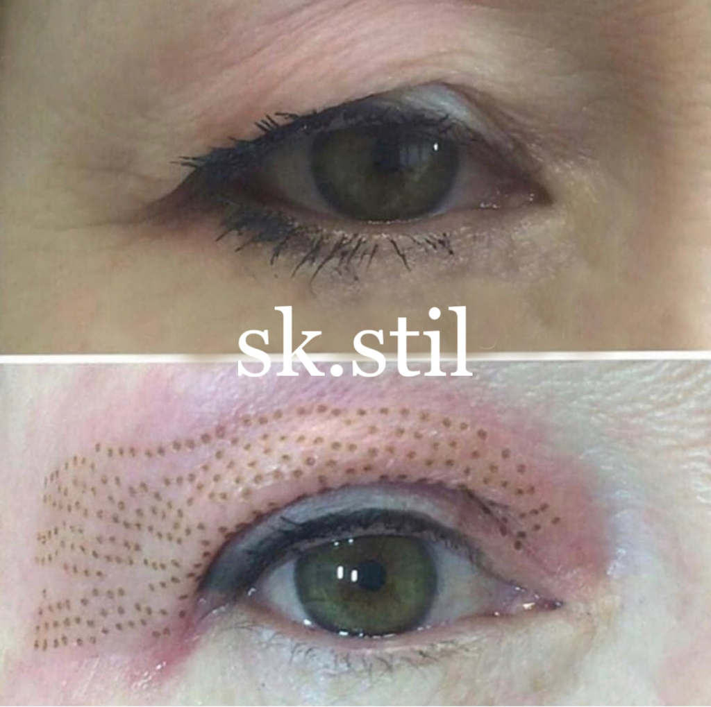 Горячая плазма(Блефаропластика верхнего века)