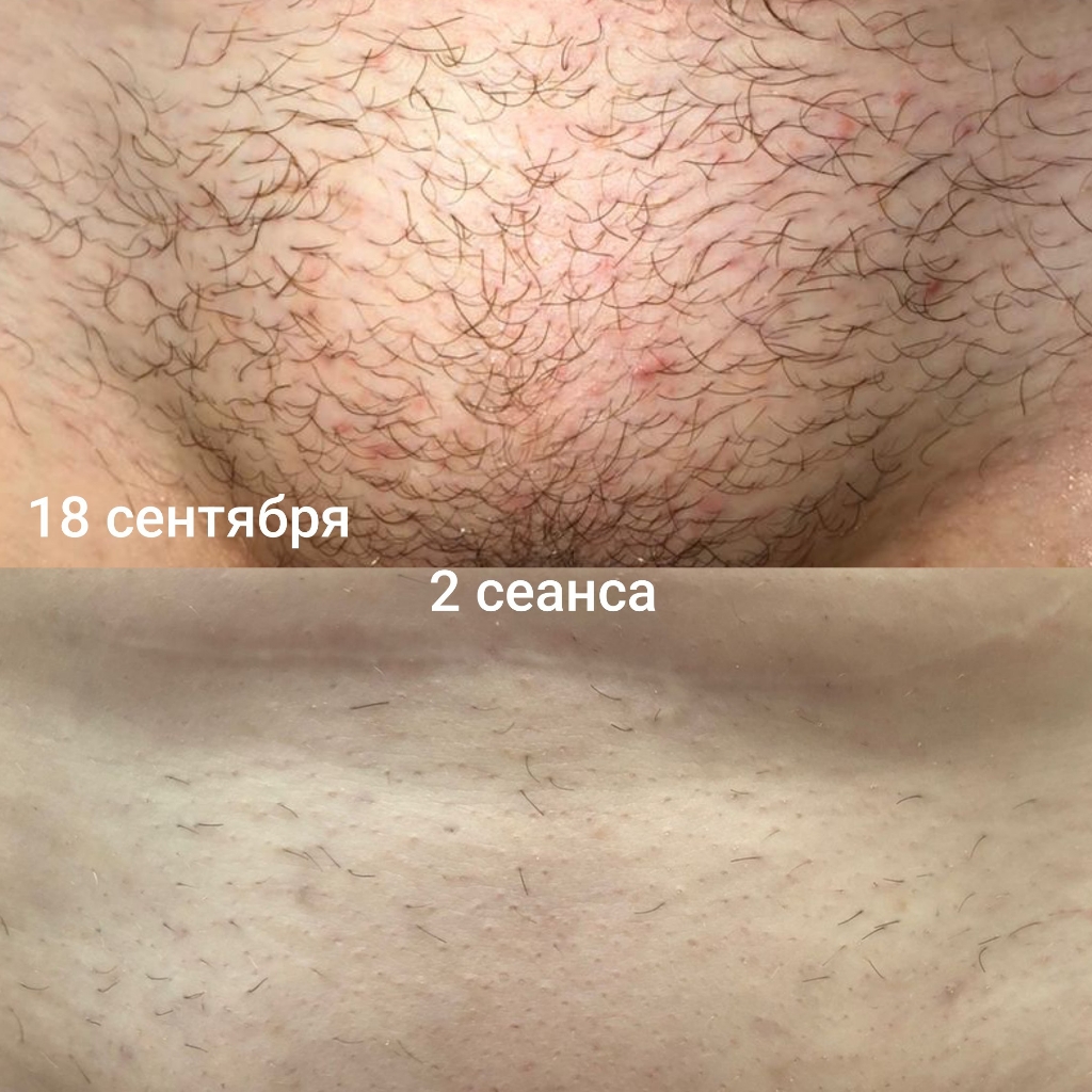 Глубокое бикини по методу 5 сеансов