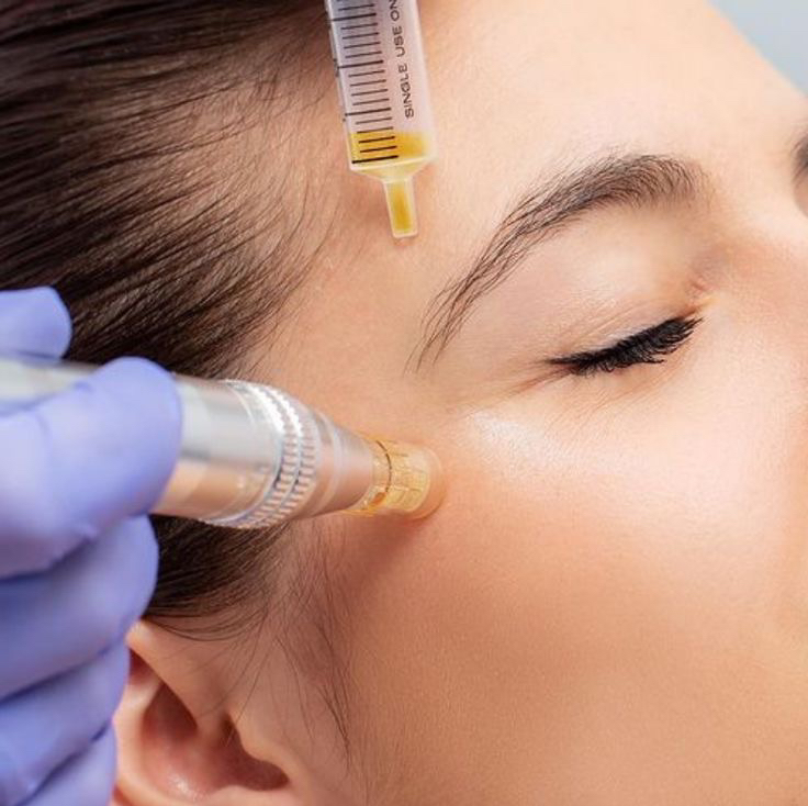 Microneedling
