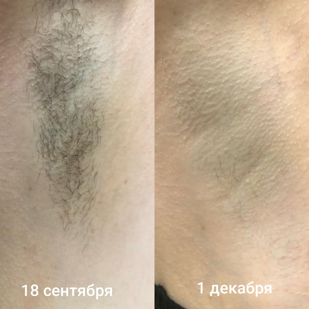 подмышки по методу 5 сеансов