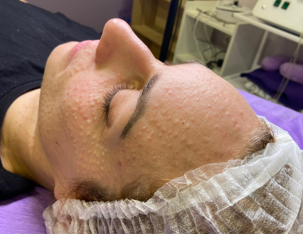 Биоревитализация