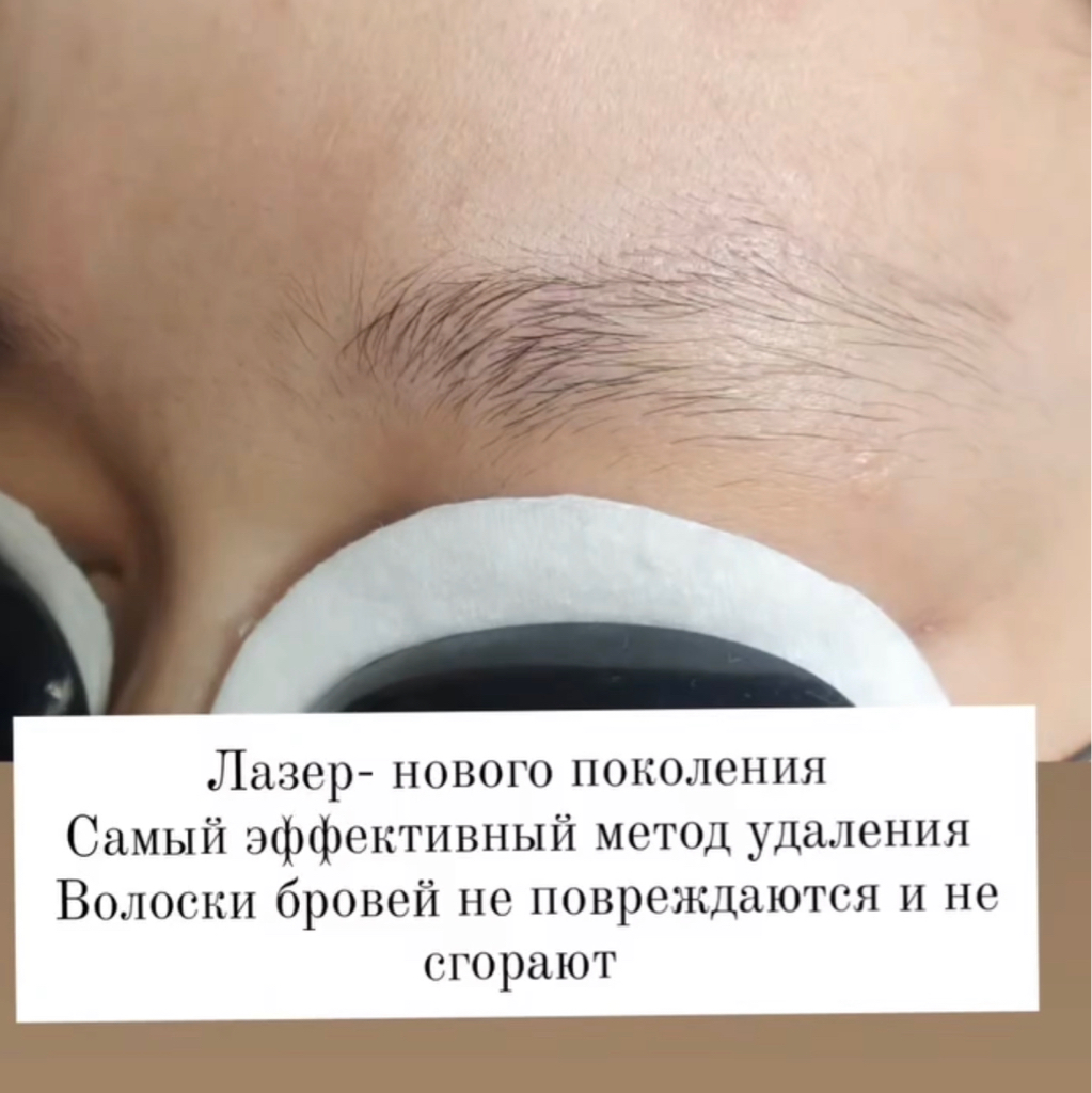 Лазерное удаление бровей