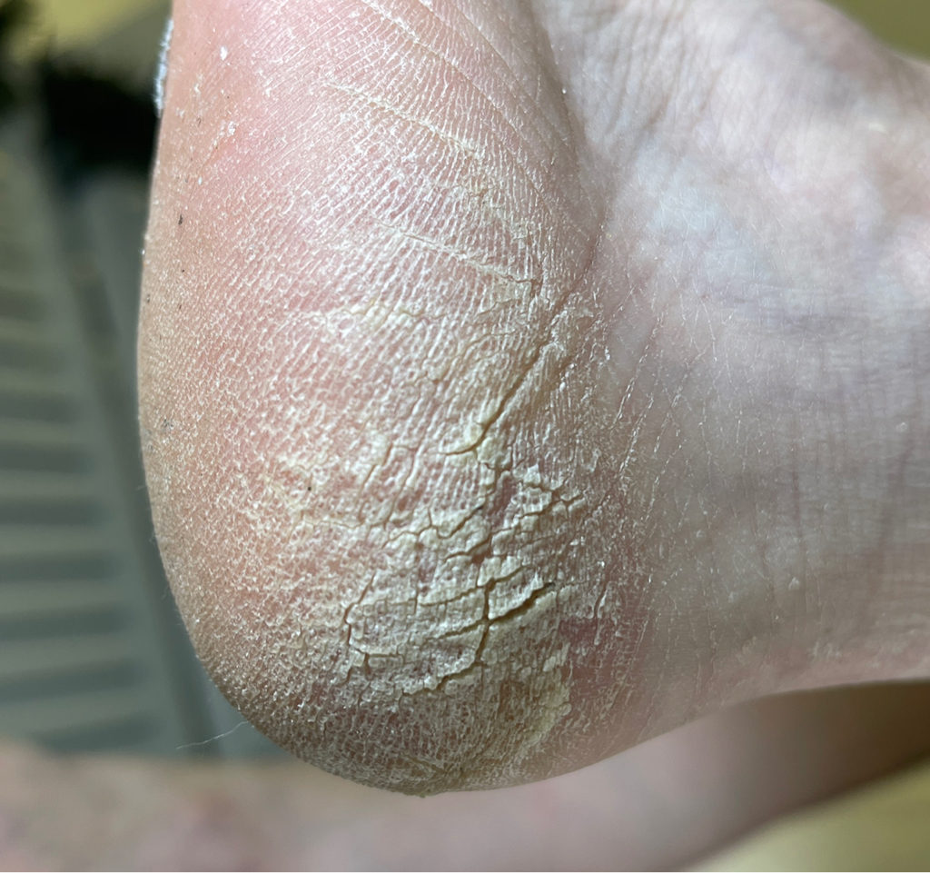 Сложная стопа - подология  (трещины, стержневые мозоли, диабетическая стопа) С ПОКРЫТИЕМ гель лак на здоровый ноготь