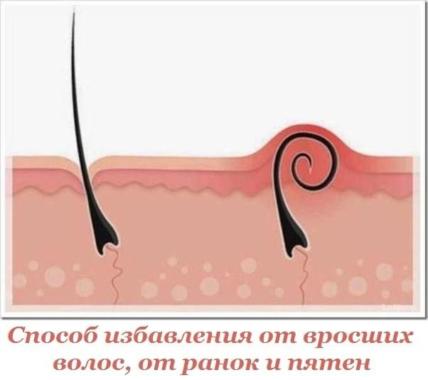 Лечение вросших волос