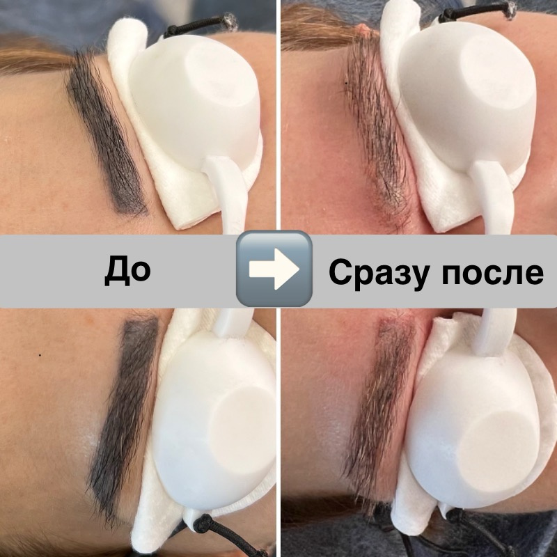 Лазерное удаление татуажа/перманента бровей