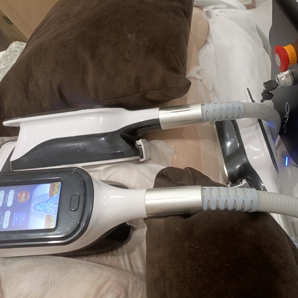 Криолиполиз (3 зоны)