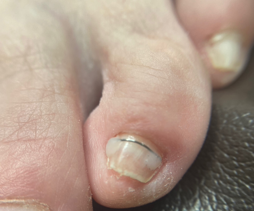 Установка титановой нити (маленькие пальцы)