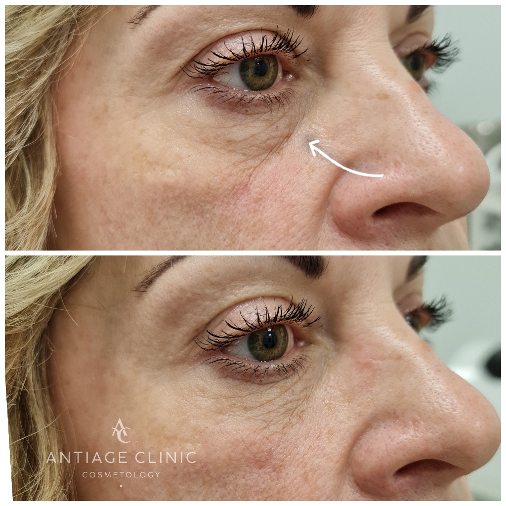 коррекция носослёзной борозды