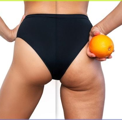 Антицеллюлитный массаж Бедра и ягодицы