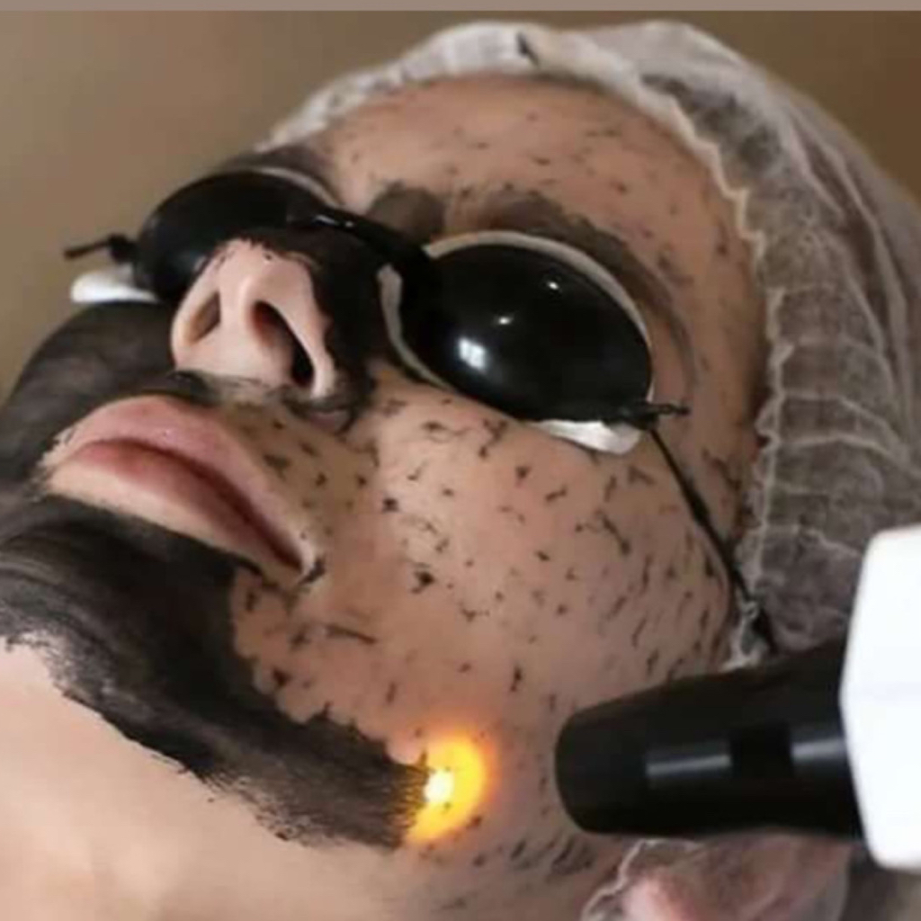 Карбоновый пилинг