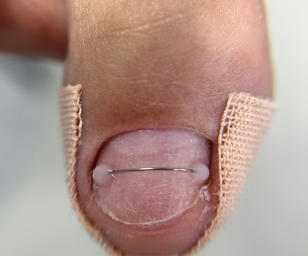 Установка титановой нити 1ед