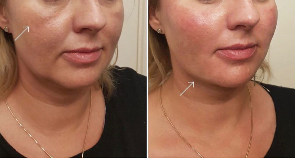 Биорепарация/липолитик по лицу HYALREPAIR - 08. 1,5 мл РУ ФСР 2010/06572