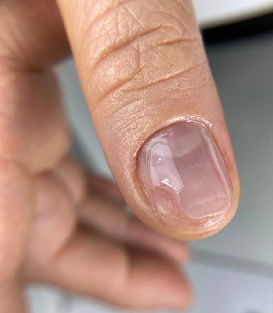 Damaged nail treatment