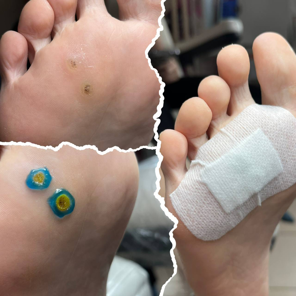 Обработка подошвенной бородавки