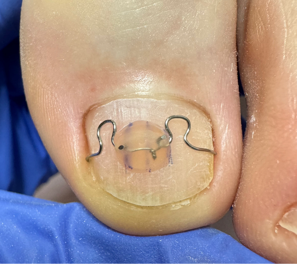 Скоба 3ТО - коррекционная система