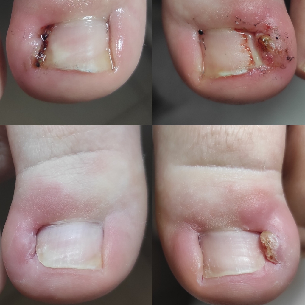 Перевязка раневого процесса 2 ногтя