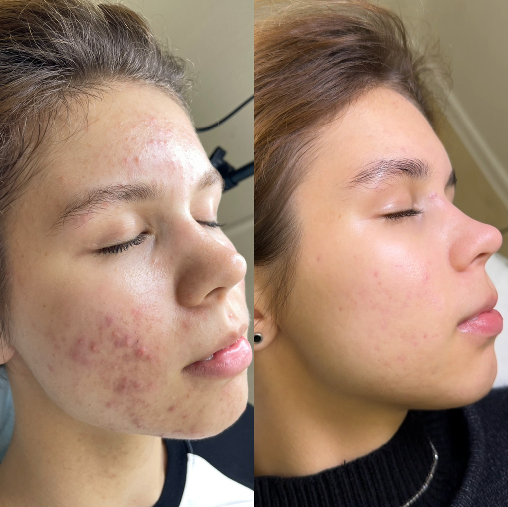 Консультация по лечению акне ОНЛАЙН ( время мск)